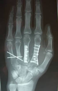 metafalangfractuur-2